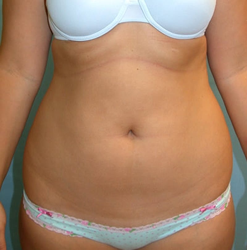 Liposuction Before & After