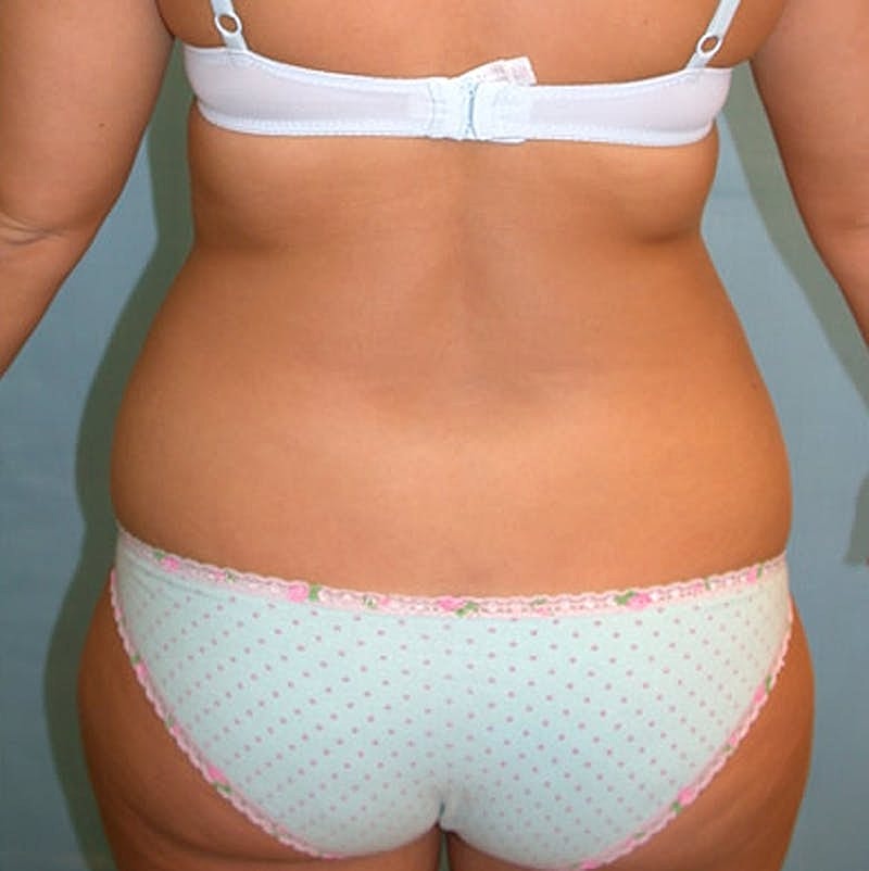 Liposuction Before & After