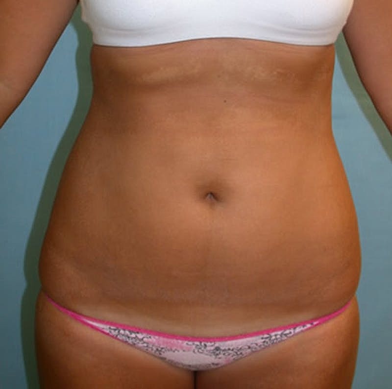Liposuction Before & After