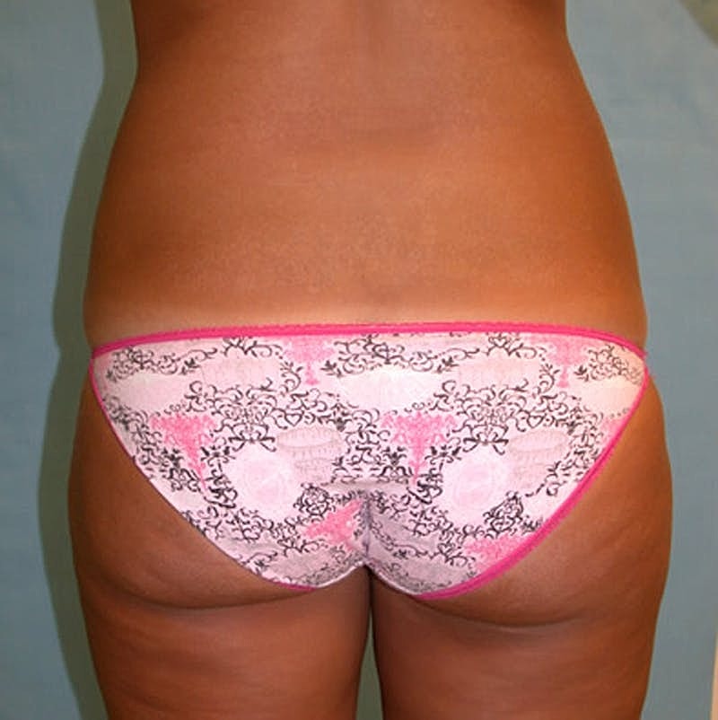 Liposuction Before & After