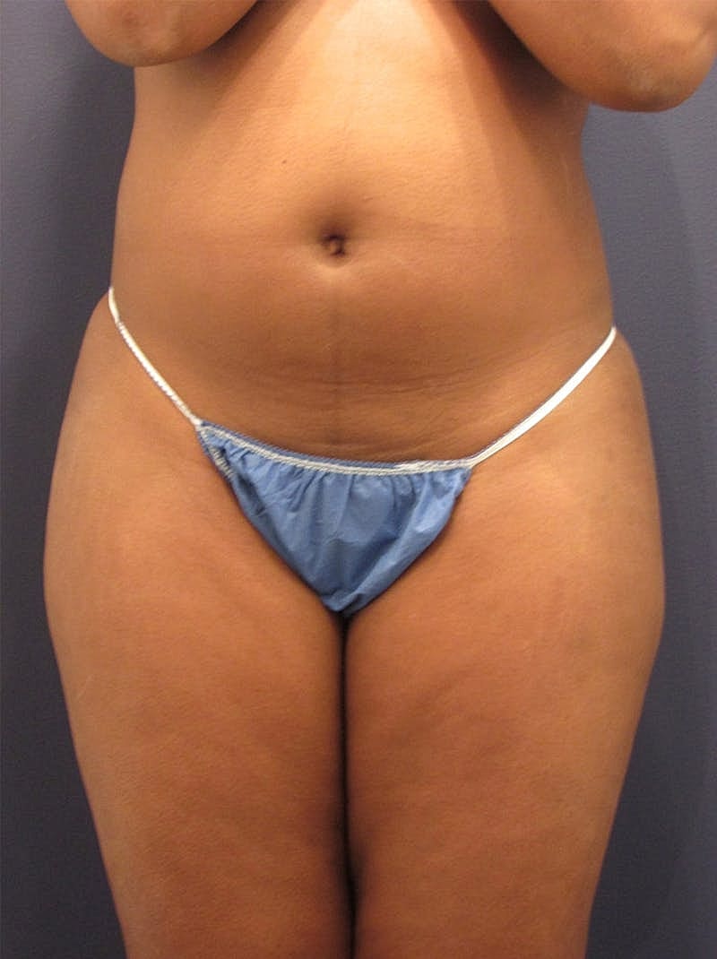 Liposuction Before & After