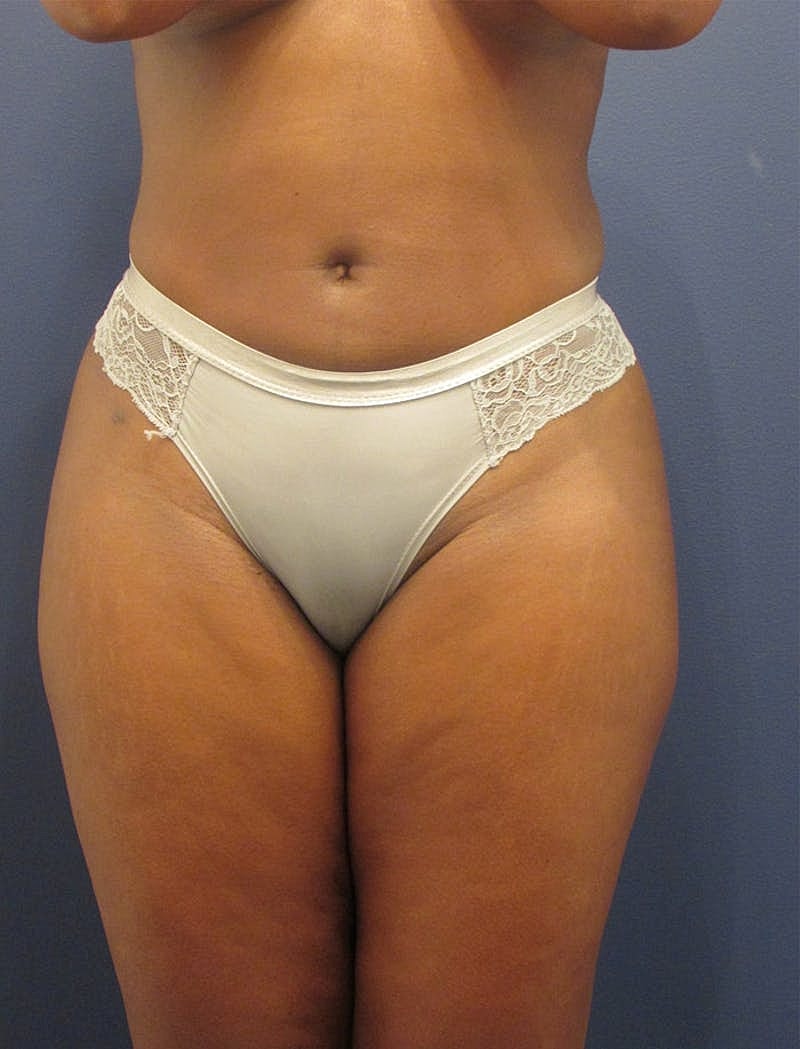Liposuction Before & After