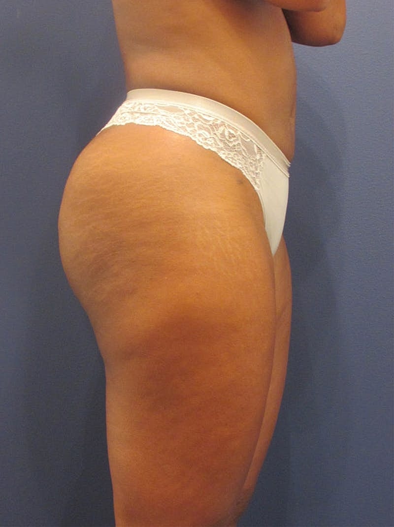 Liposuction Before & After