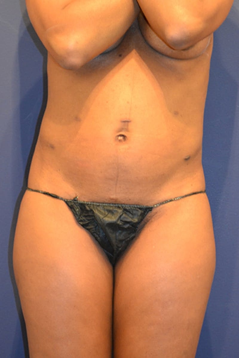 Liposuction Before & After