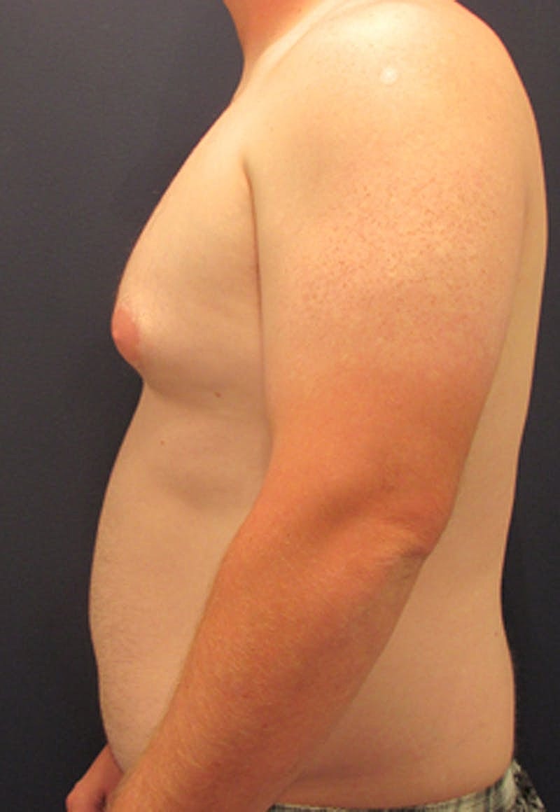 Liposuction Before & After