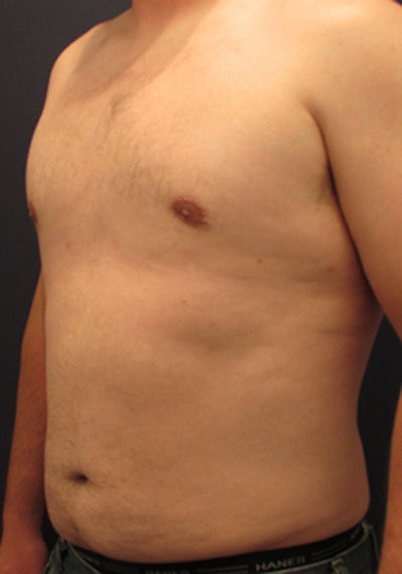 Liposuction Before & After