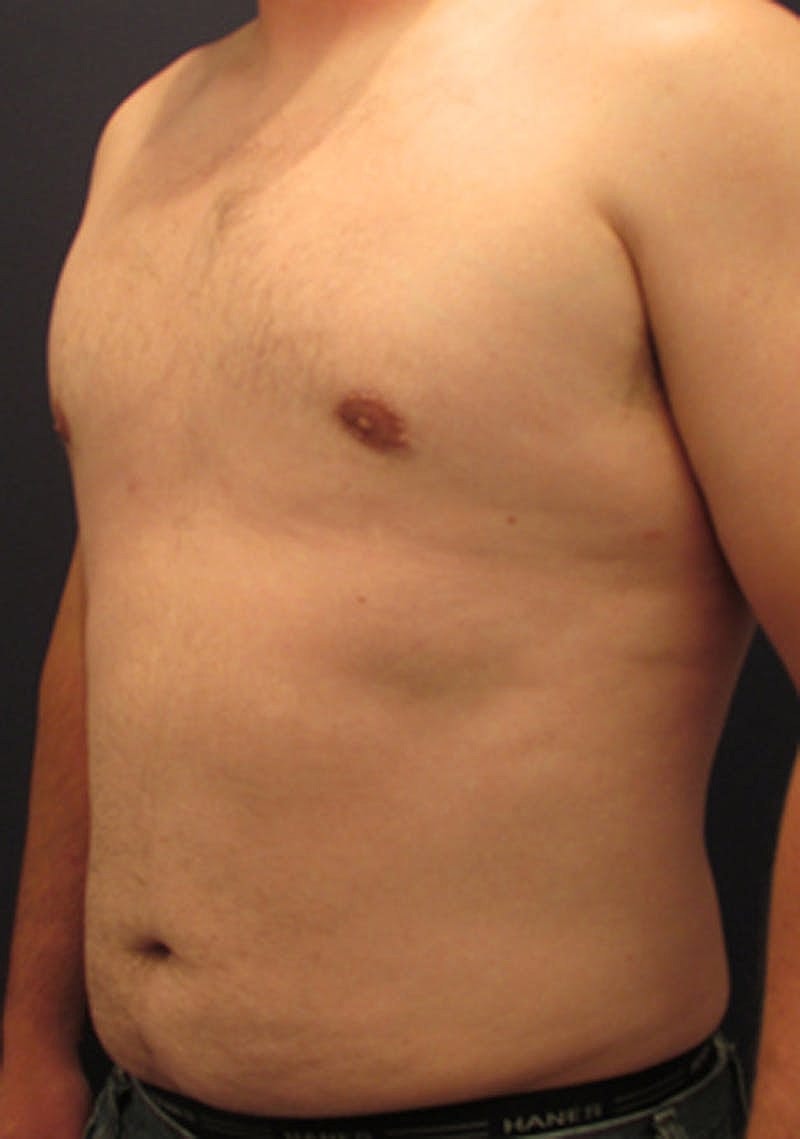 Liposuction Before & After
