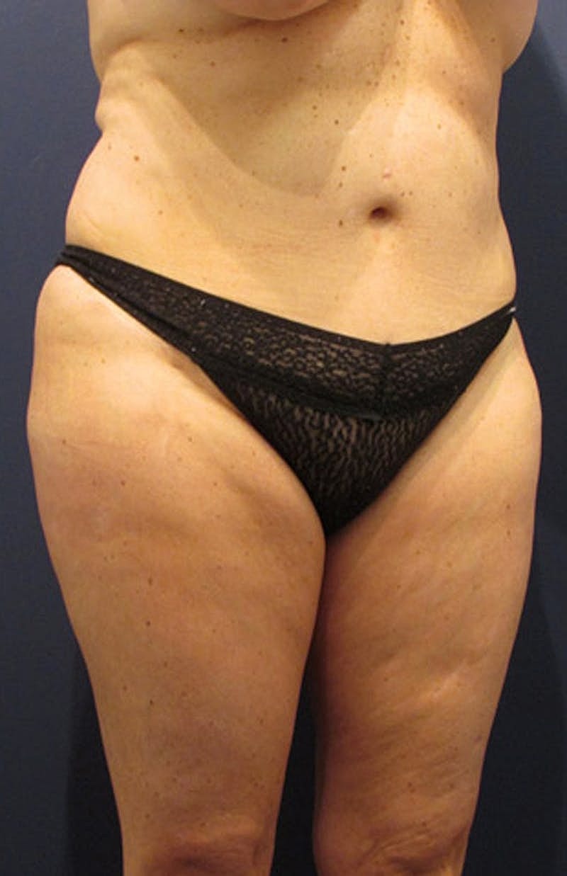 Liposuction Before & After