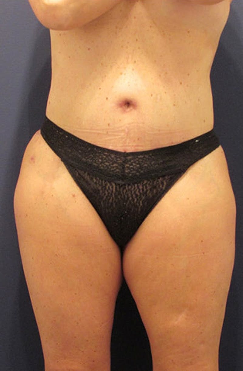 Liposuction Before & After