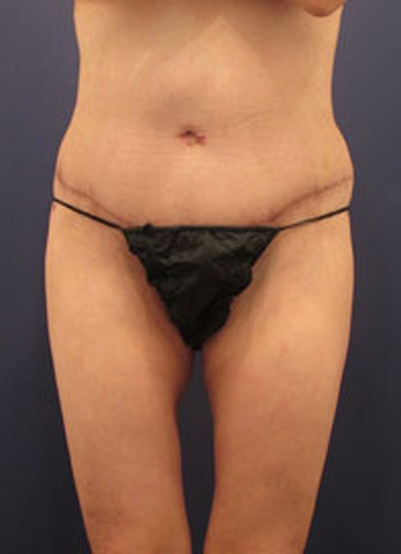 Liposuction Before & After