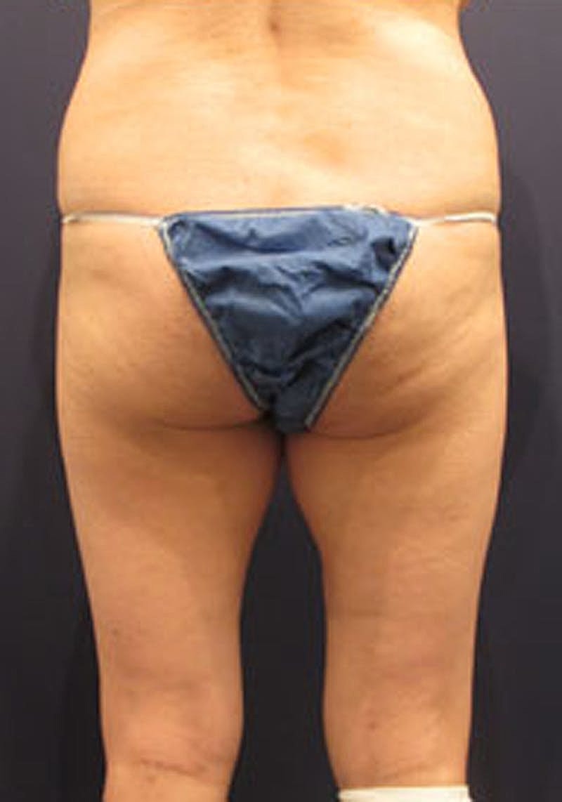 Liposuction Before & After
