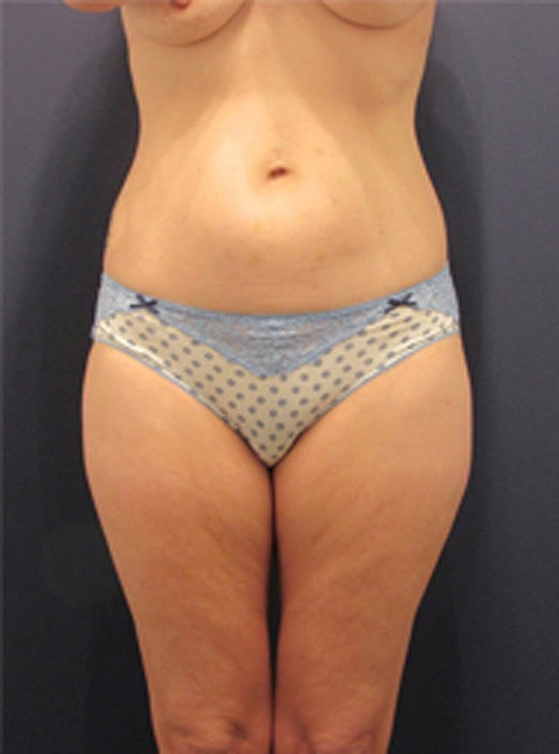 Liposuction Before & After