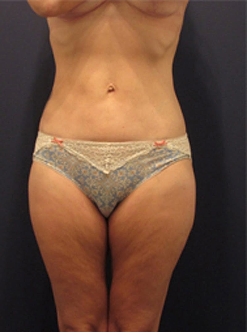 Liposuction Before & After