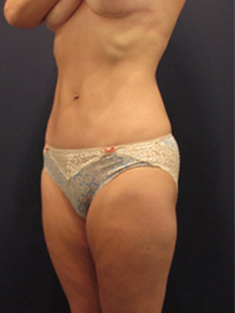Liposuction Before & After