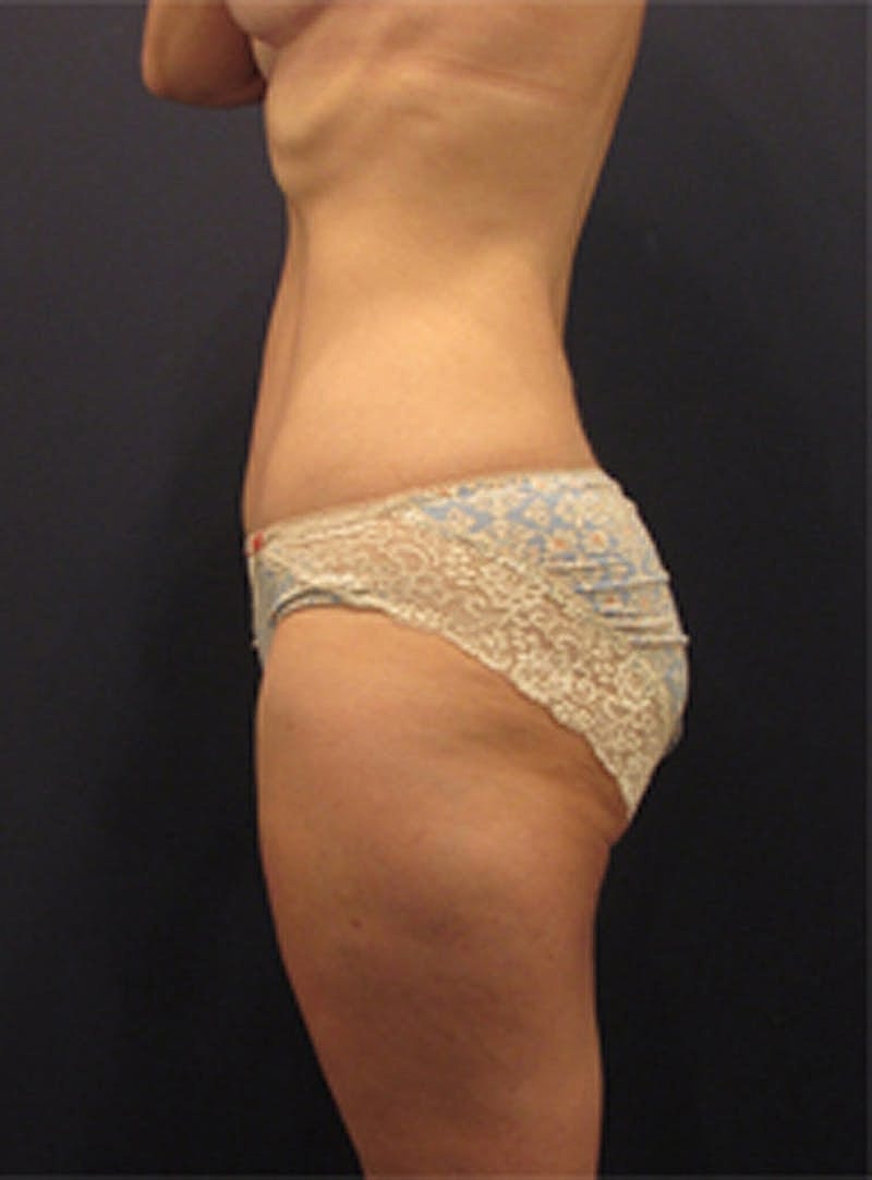 Liposuction Before & After