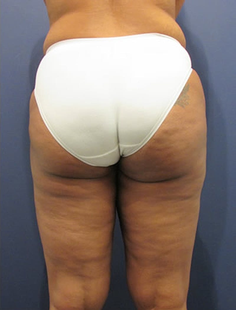 Liposuction Before & After