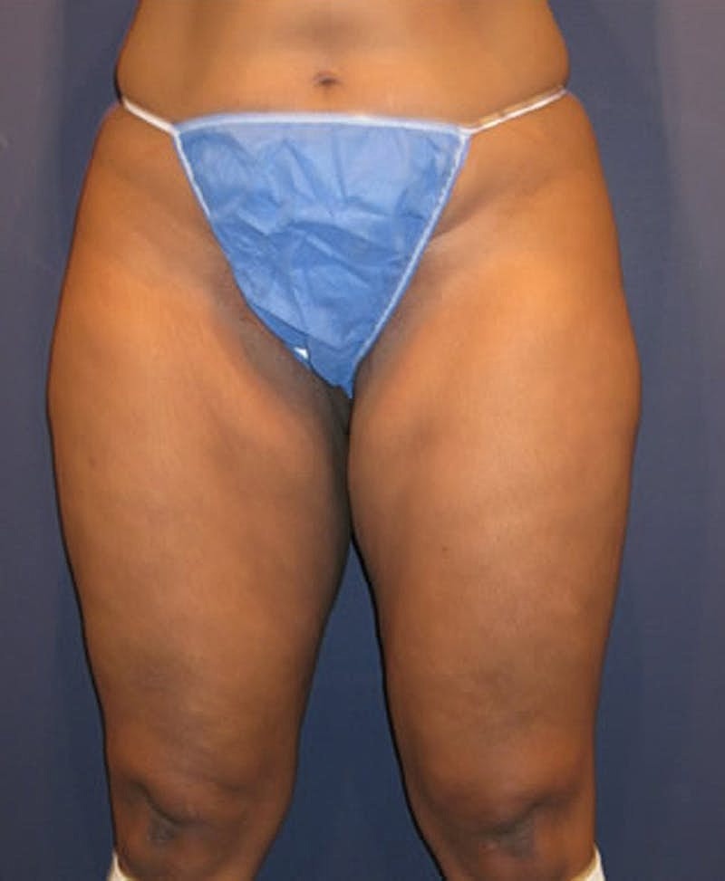 Liposuction Before & After
