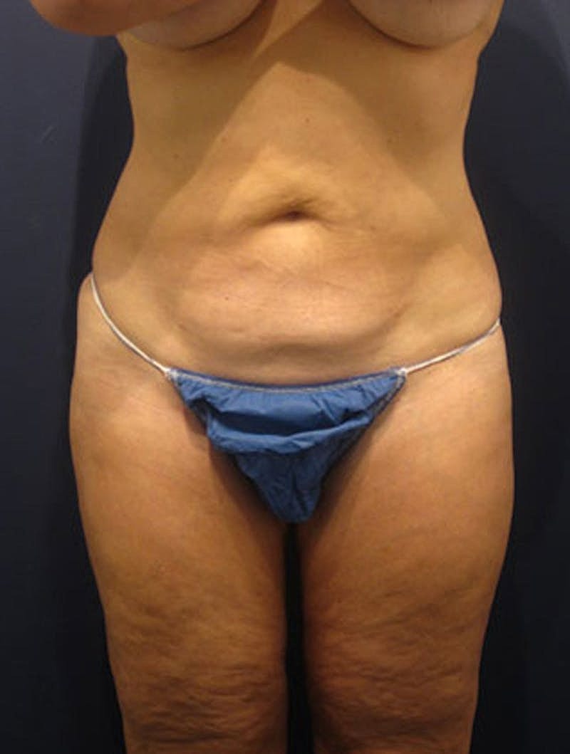 Liposuction Before & After