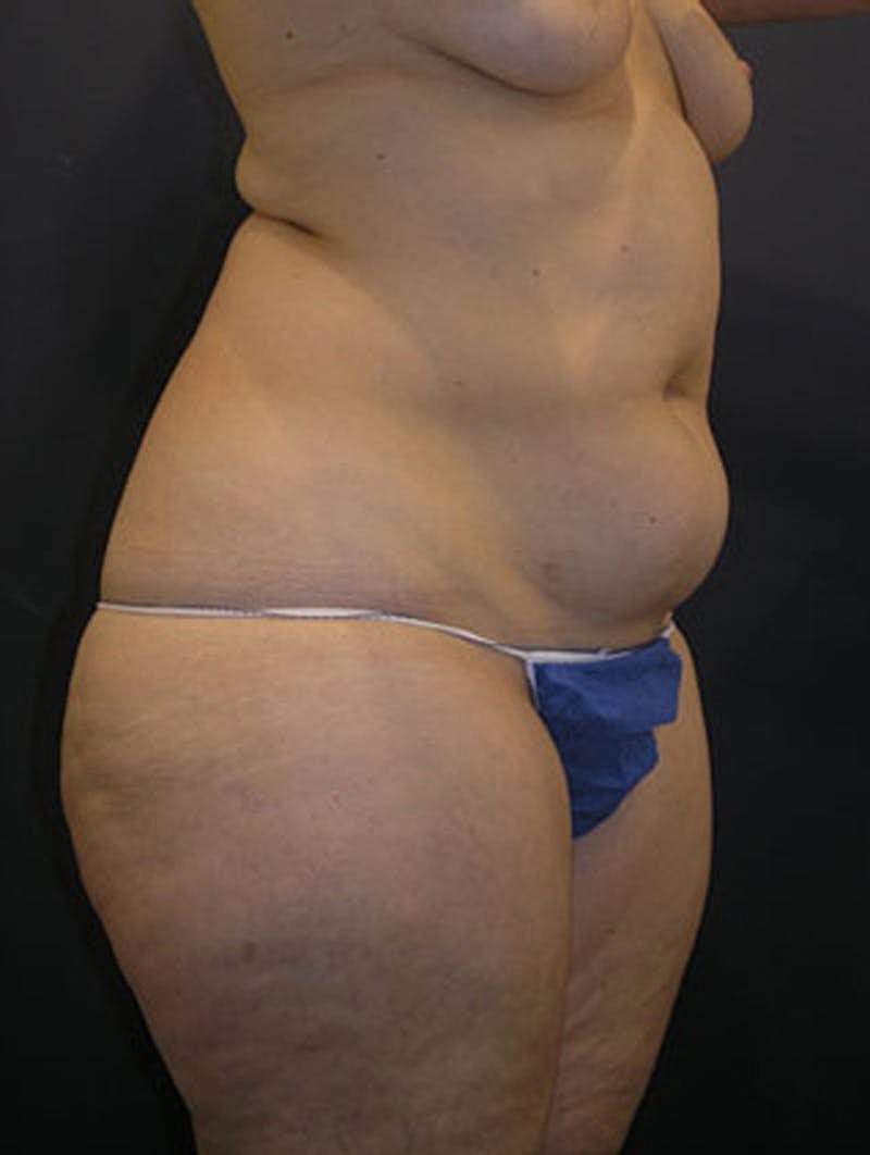 Liposuction Before & After