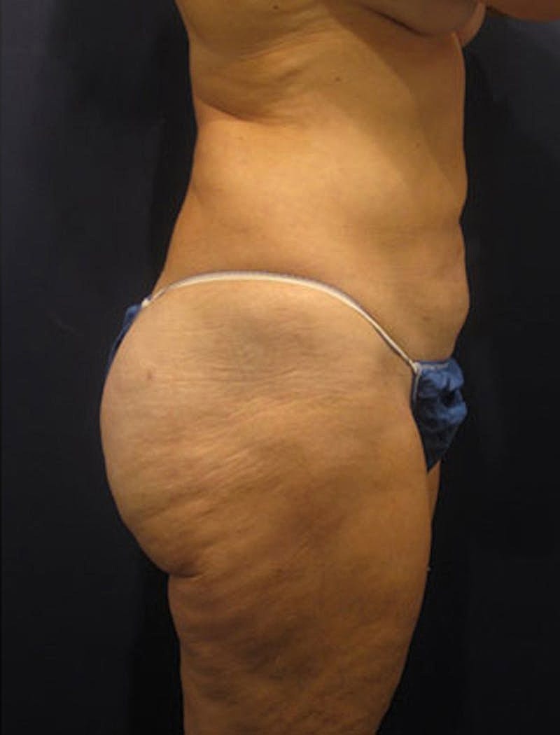 Liposuction Before & After