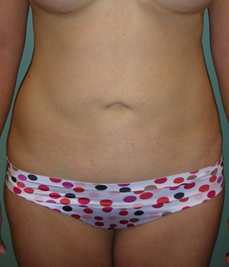 Liposuction Before & After