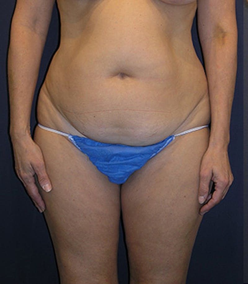 Liposuction Before & After