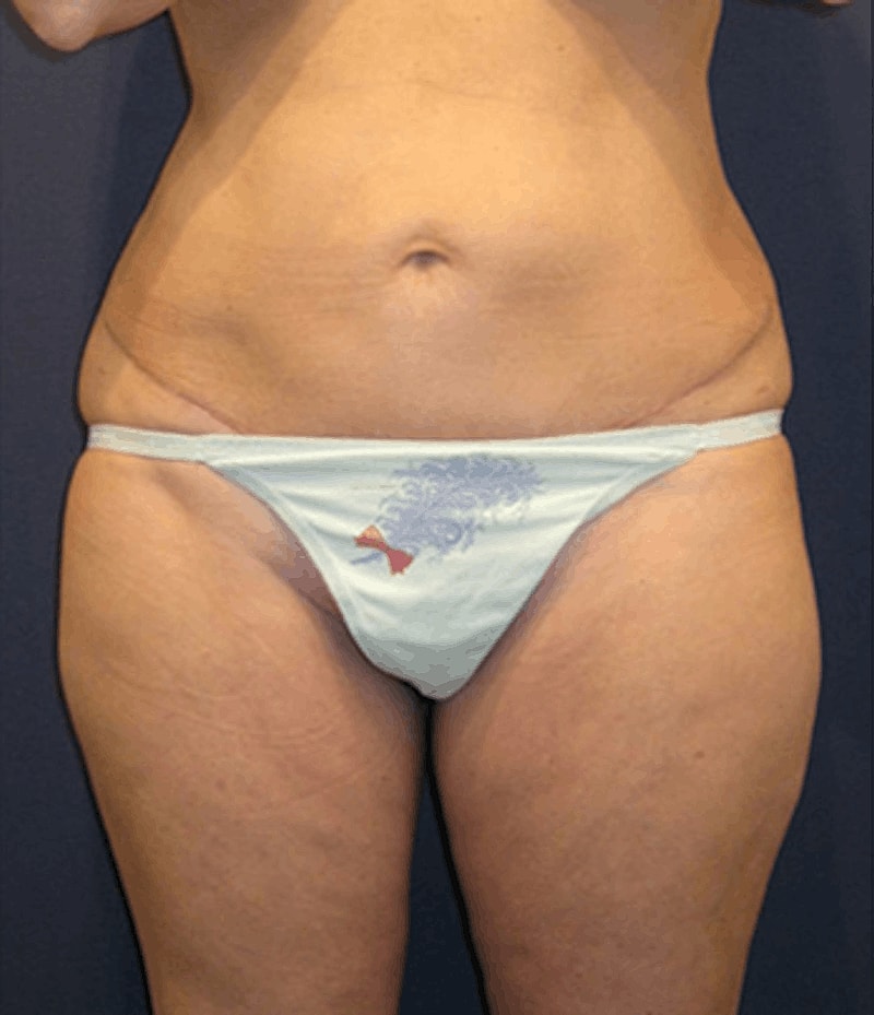 Liposuction Before & After