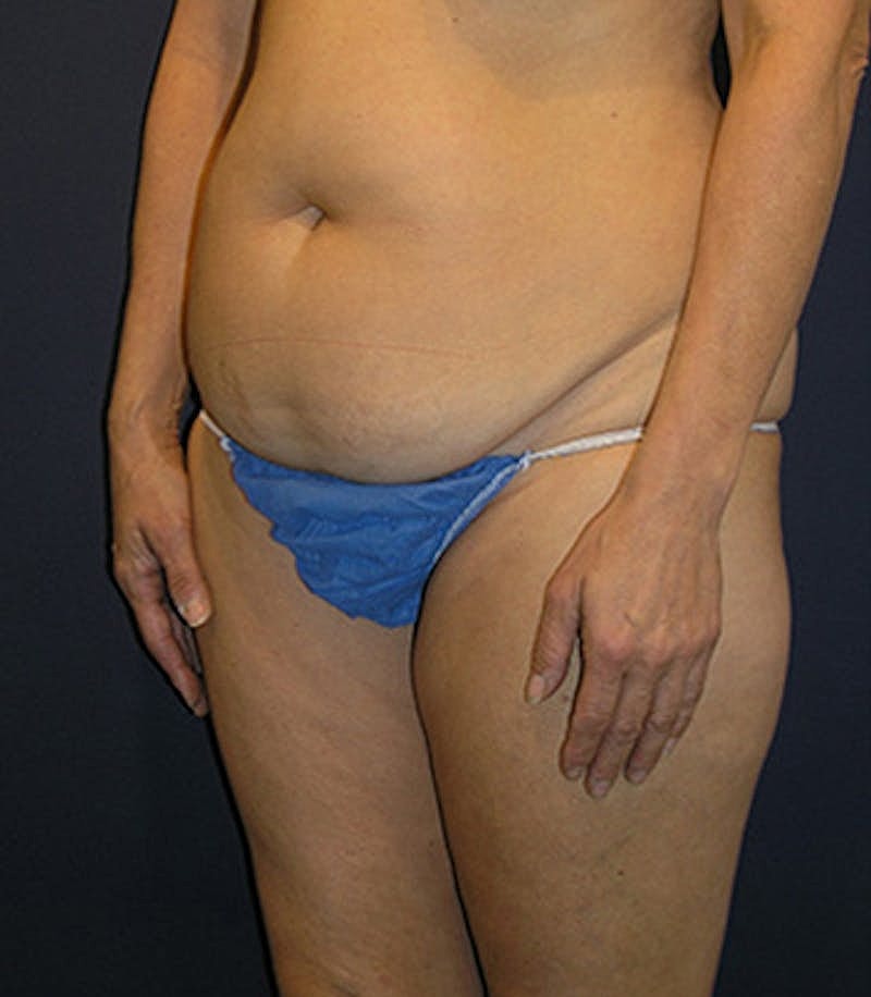 Liposuction Before & After