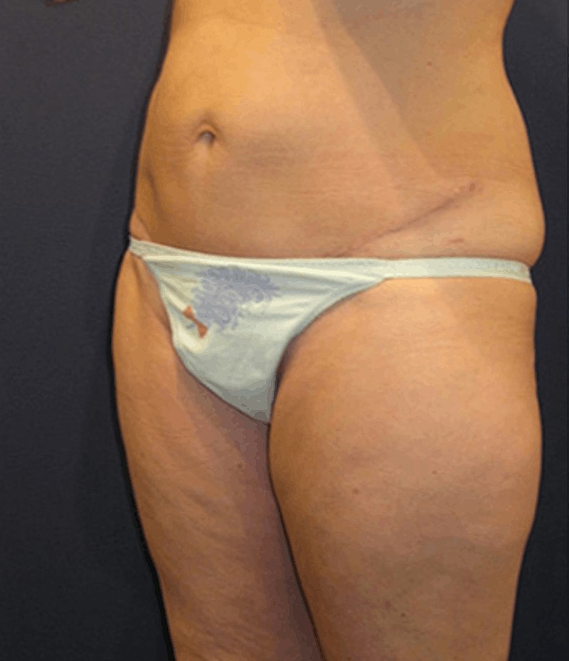 Liposuction Before & After