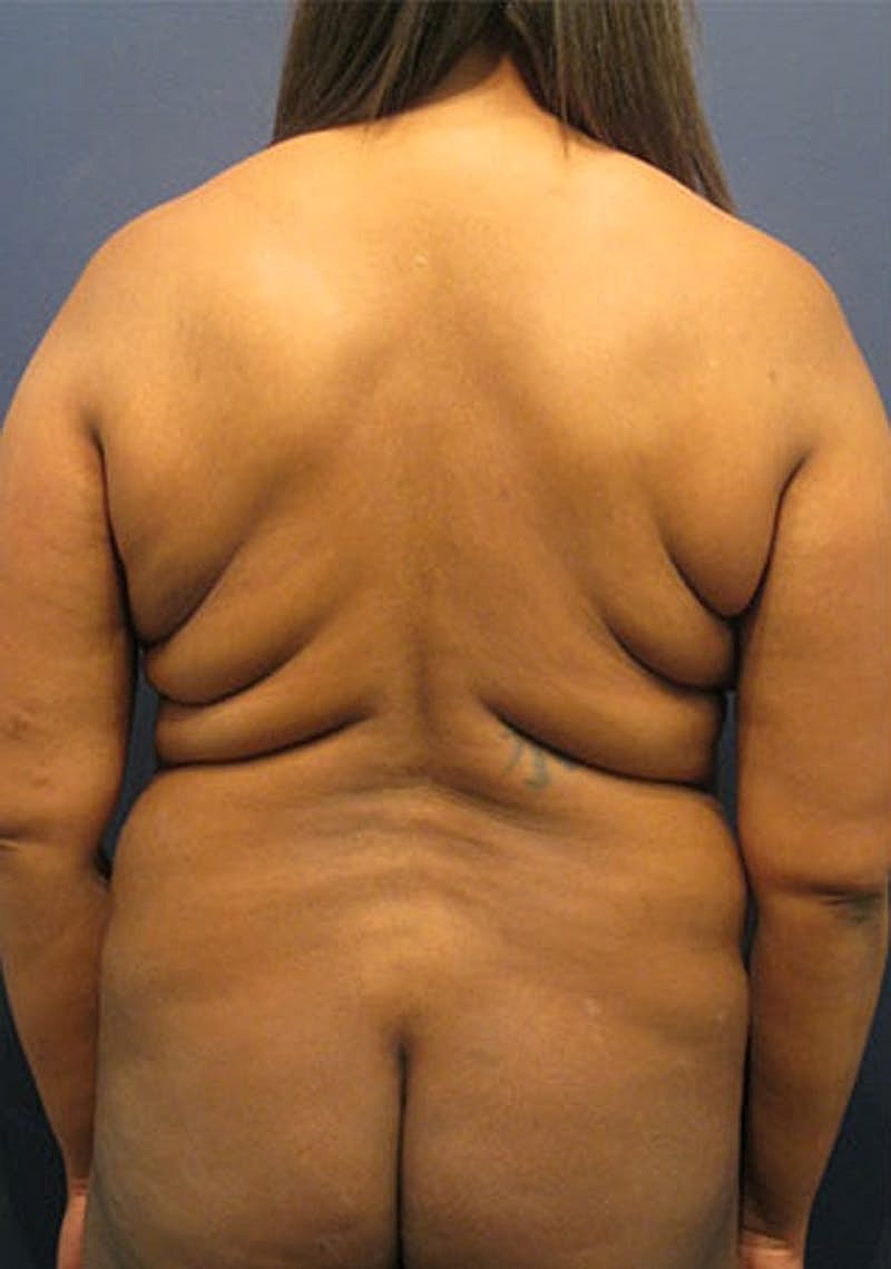 Liposuction Before & After