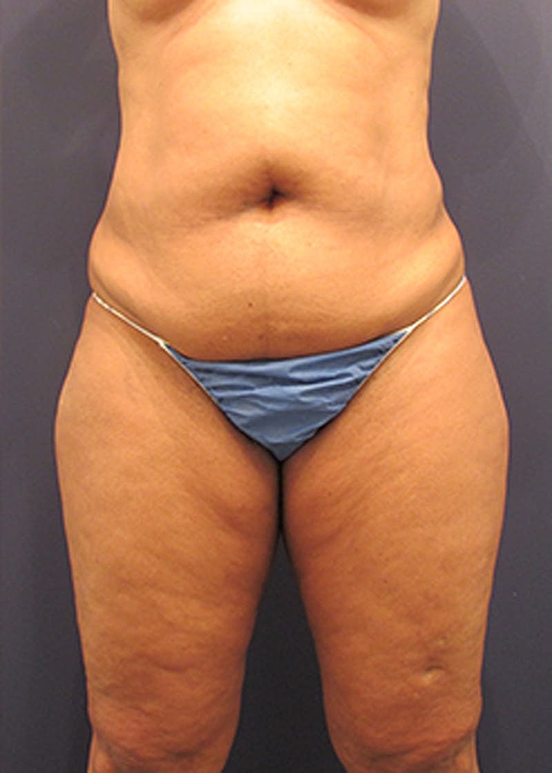 Liposuction Before & After