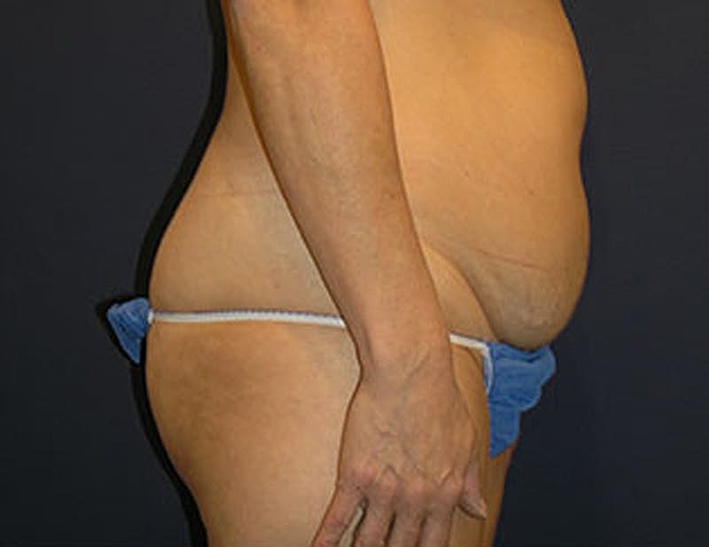 Liposuction Before & After