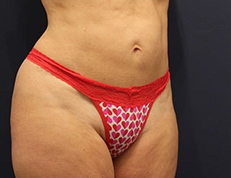 Liposuction Before & After