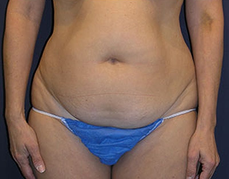 Liposuction Before & After