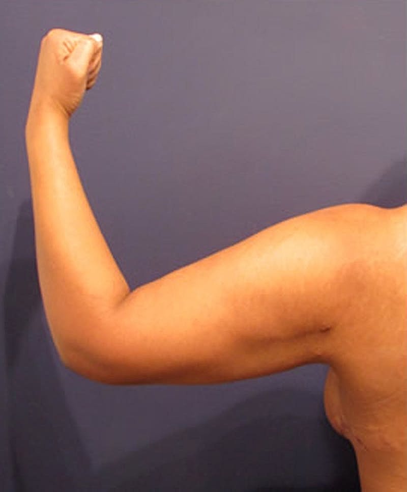 Liposuction Before & After