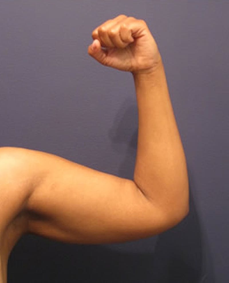 Liposuction Before & After