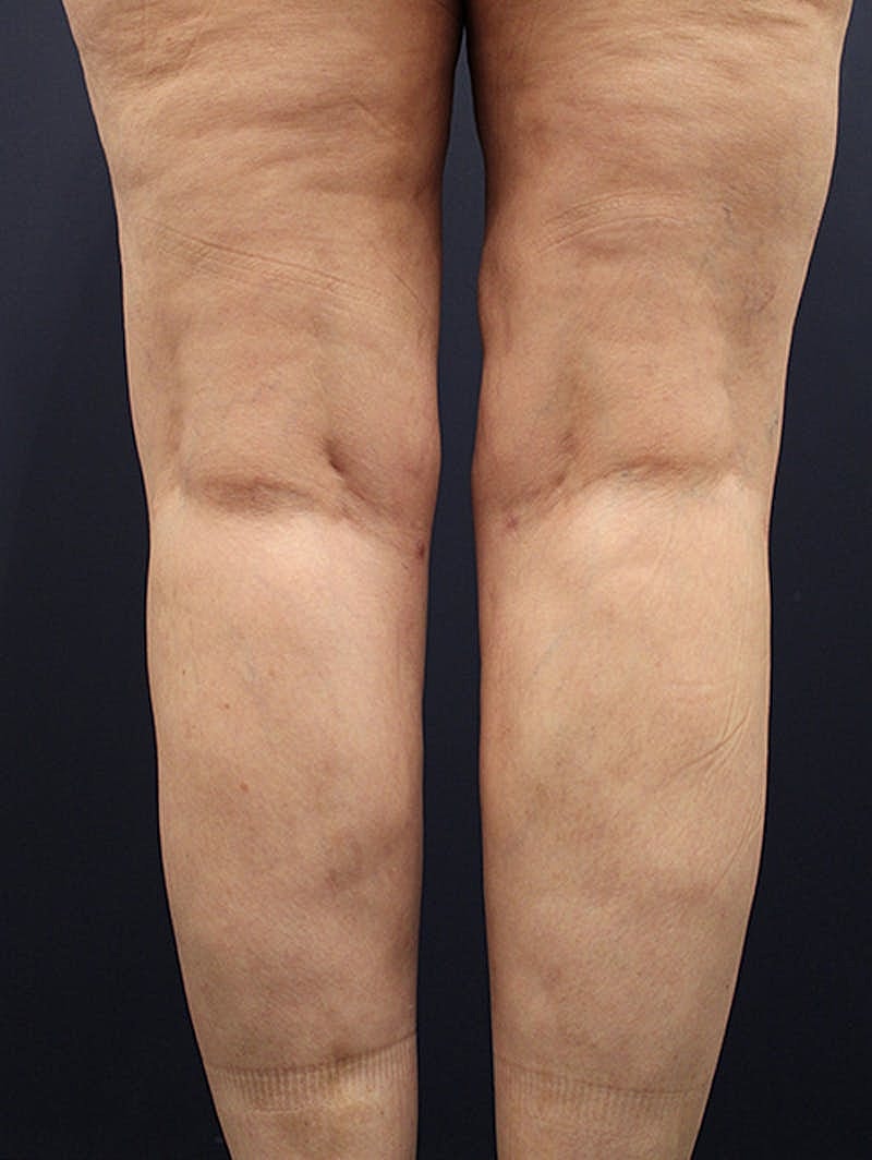 Liposuction Before & After