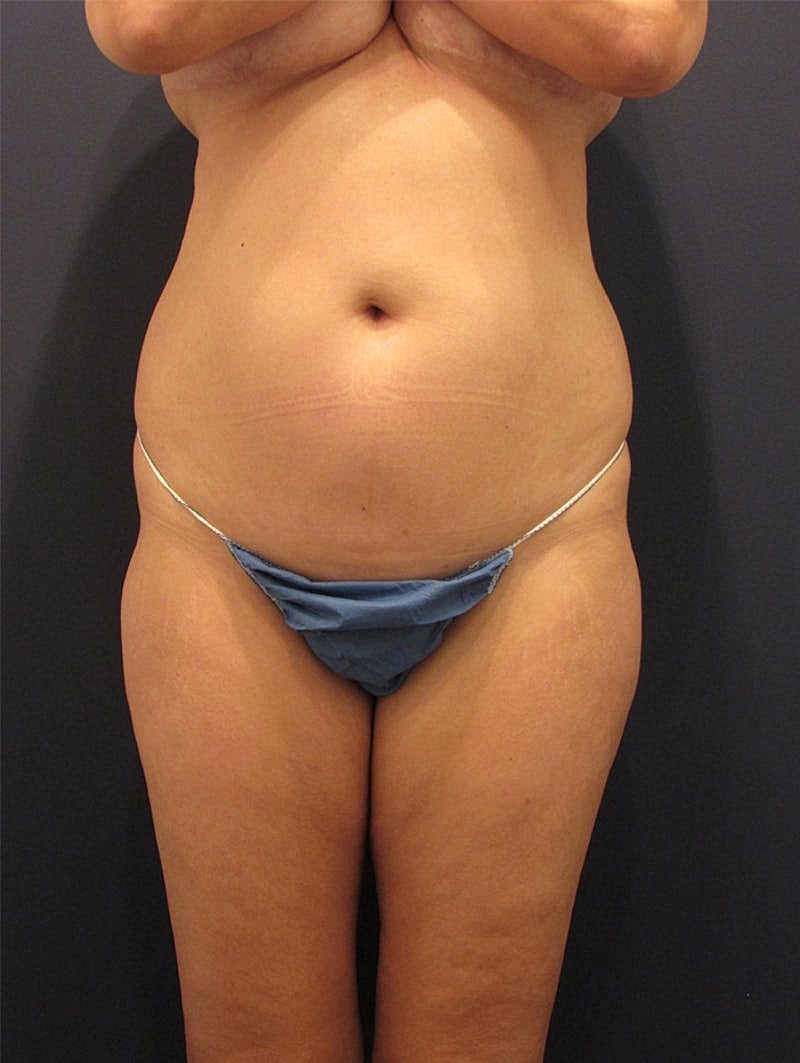 Liposuction Before & After