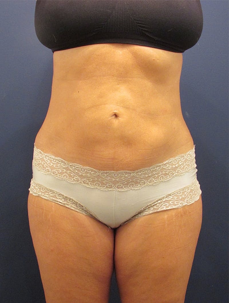 Liposuction Before & After