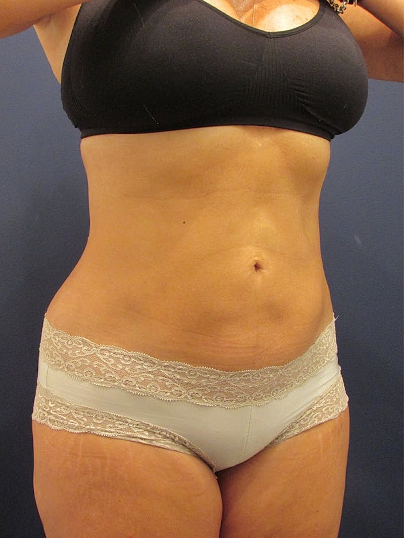 Liposuction Before & After