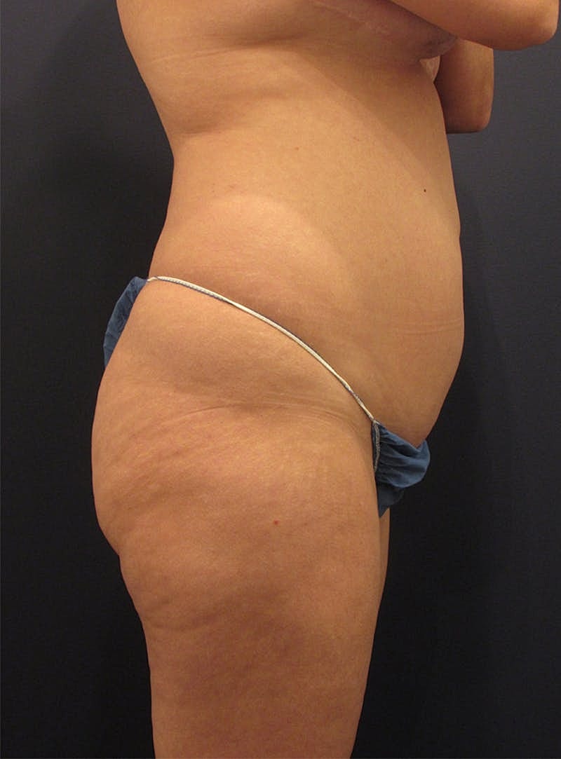 Liposuction Before & After