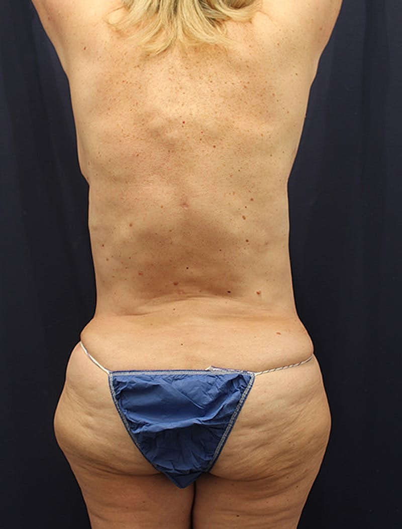 Liposuction Before & After
