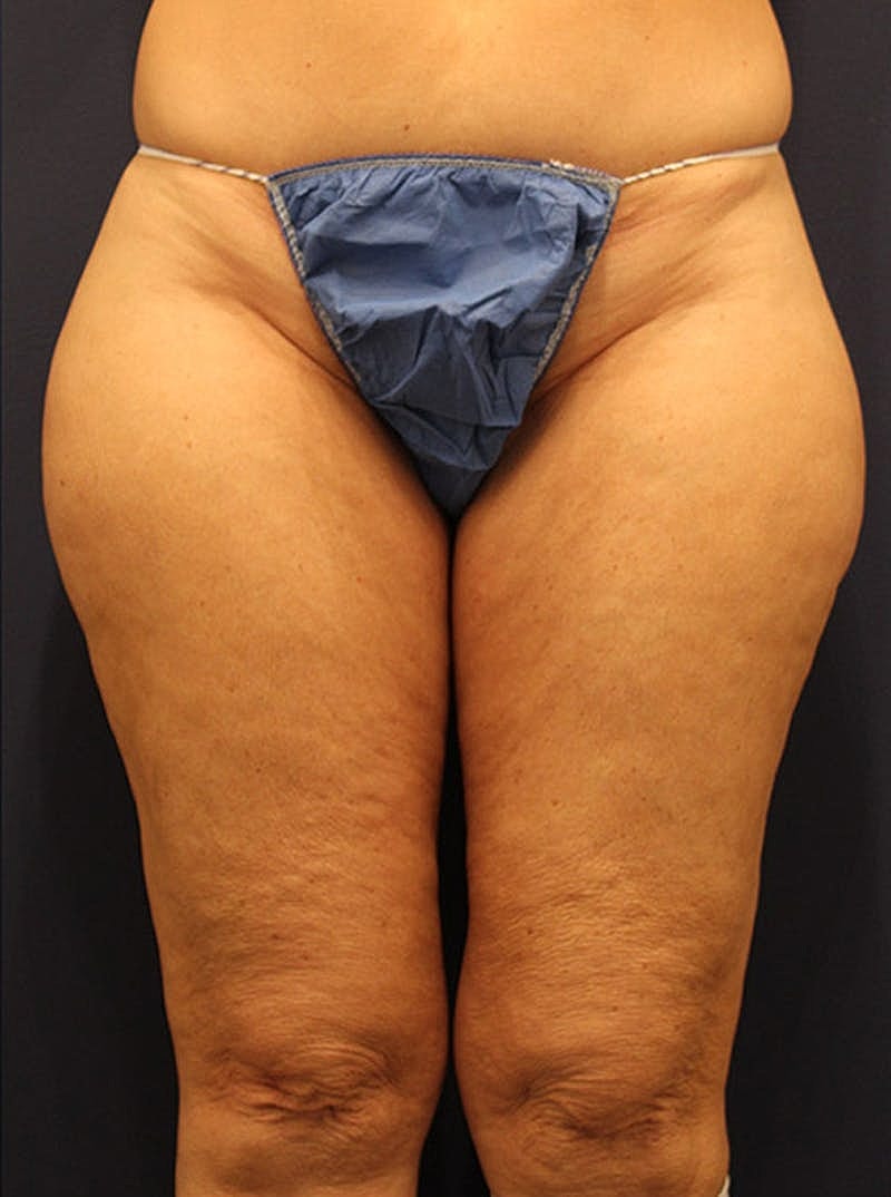 Liposuction Before & After