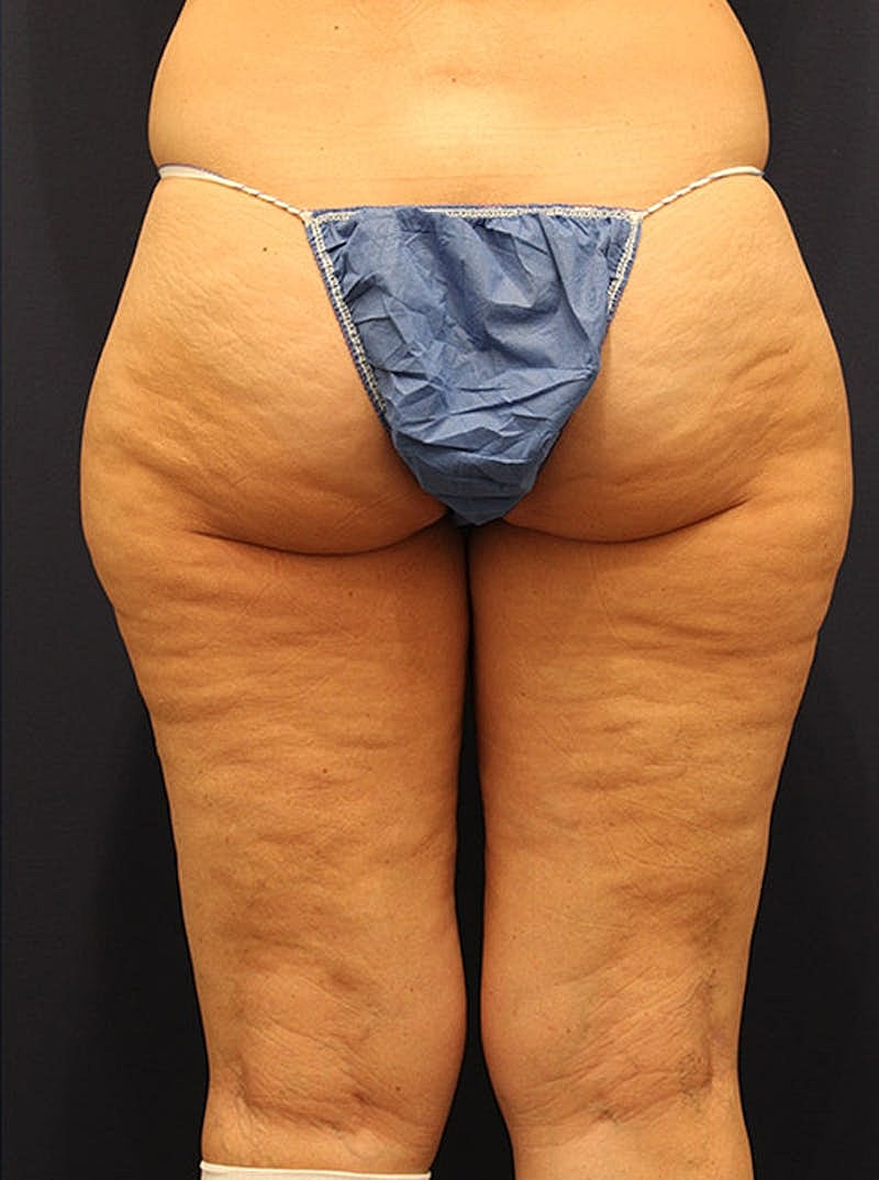 Liposuction Before & After