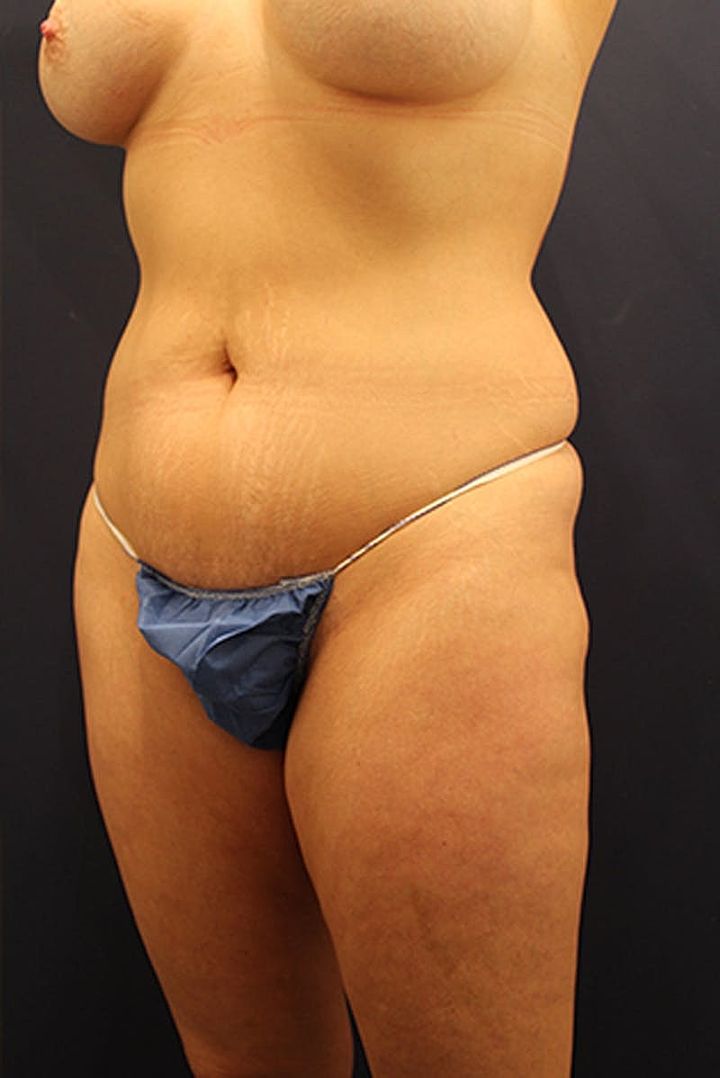 Liposuction Before & After