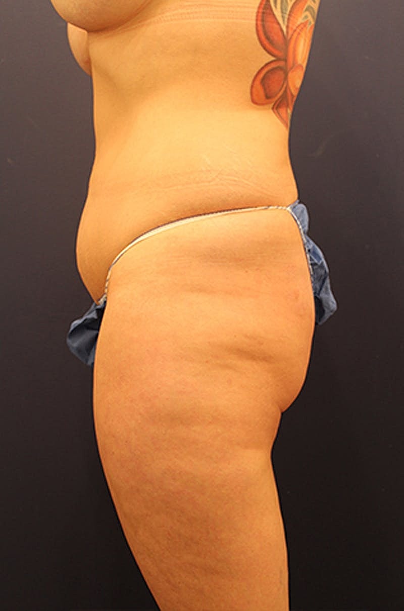Liposuction Before & After