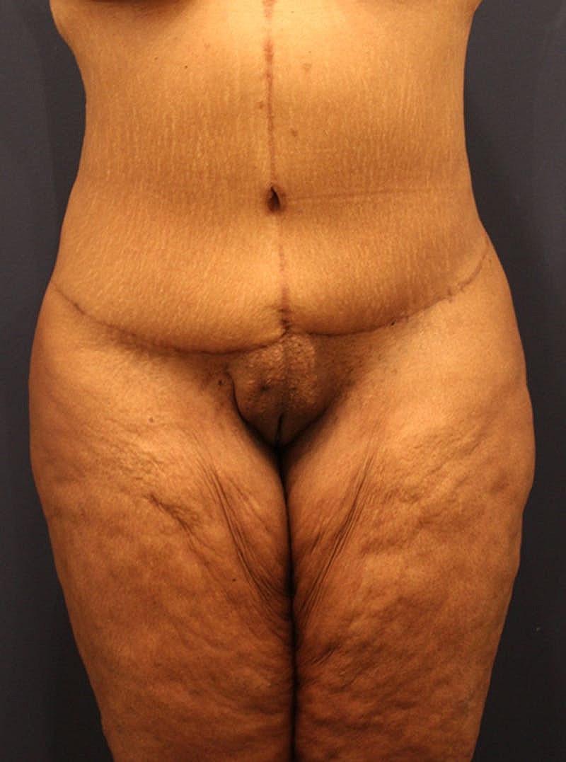 Liposuction Before & After