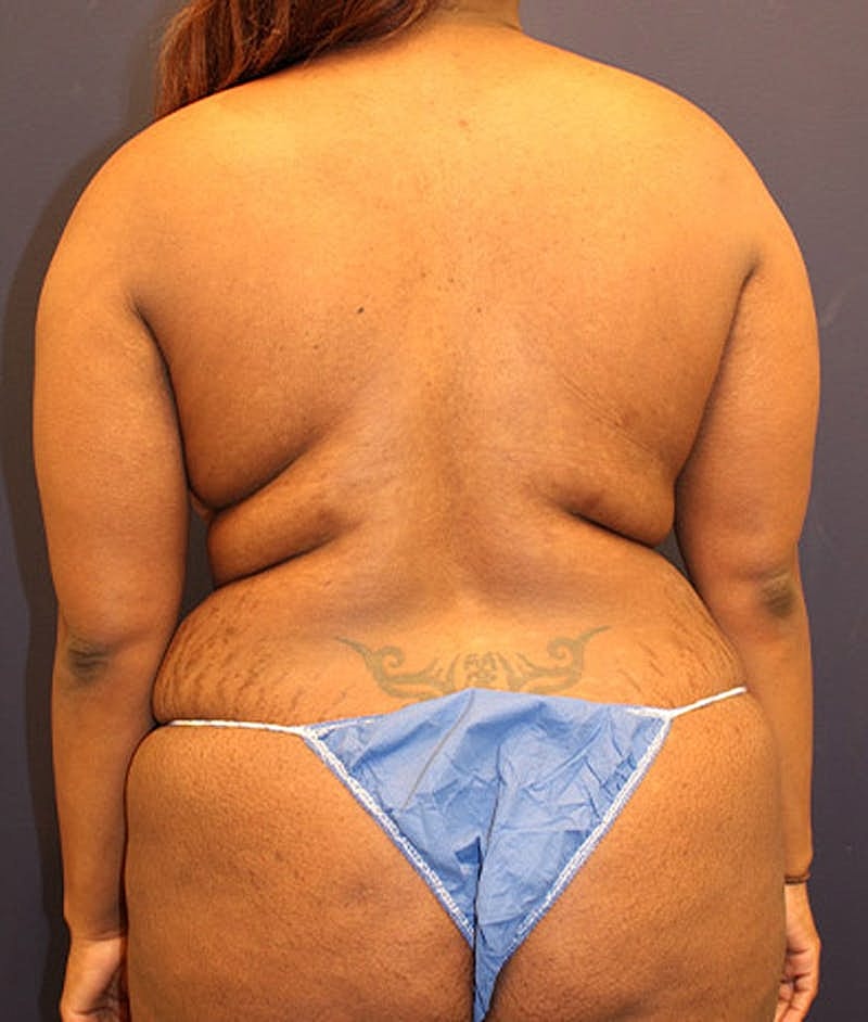 Liposuction Before & After