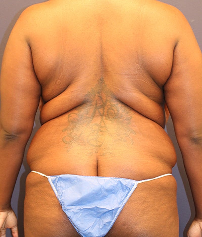 Liposuction Before & After