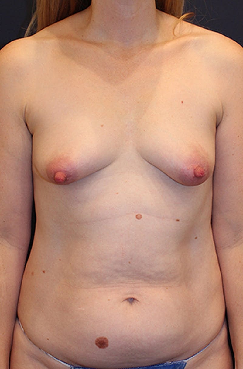 Liposuction Before & After